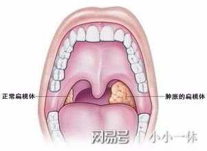 女子上厕所闻到恶臭当晚扁桃体发炎，一次意外的健康警报